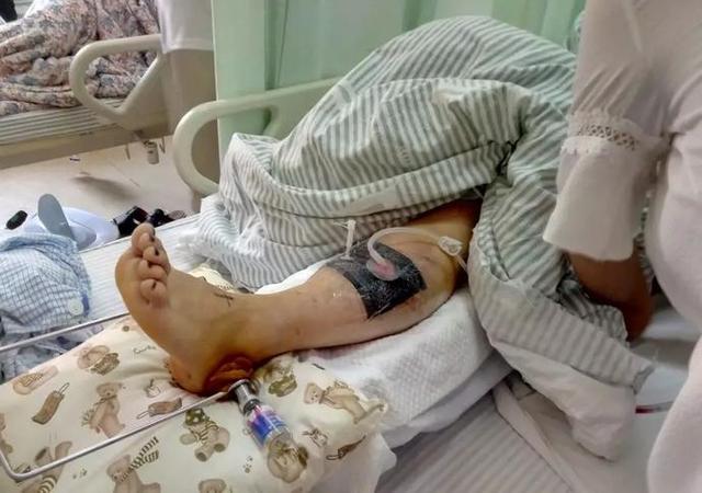 女子遛弯被不明物体击中小腿 血肉模糊鲜血直淌