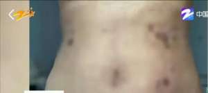 美女自缚自述(体重100斤美女做抽脂手术，哭诉：我老公都不敢碰我的肚子)