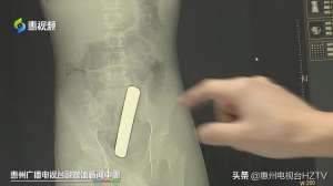 猎奇美女肛塞图片(这种好奇要不得小伙将12公分铜条“塞进”体内 差点扎破肠子)