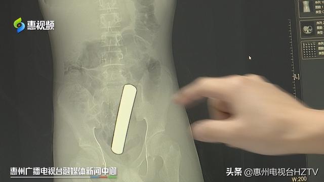 这种好奇要不得!小伙将12公分铜条“塞进”体内 差点扎破肠子