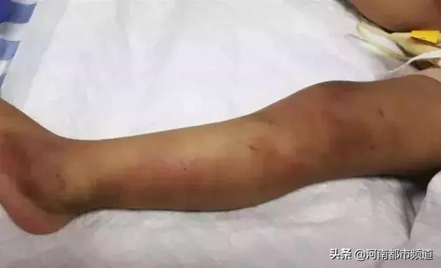 一岁多女童被钢管戳胸、烟头烫肤,最后被母亲男友摔死,检察官边办案边流泪