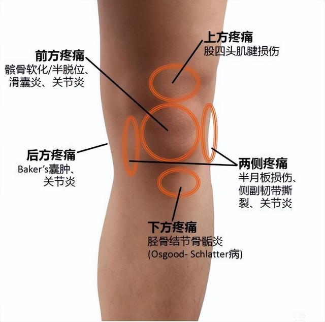 膝盖不同位置的疼痛,分别意味着什么?看完这张图,你马上就明白
