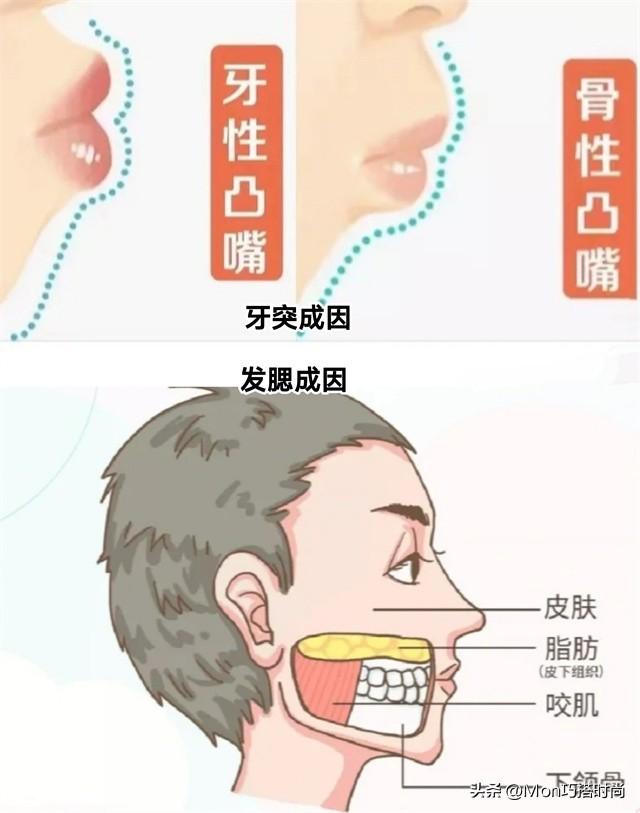 牙突不算什么,“发腮”才是真的拉垮,显凶又老态,太多人遭殃了