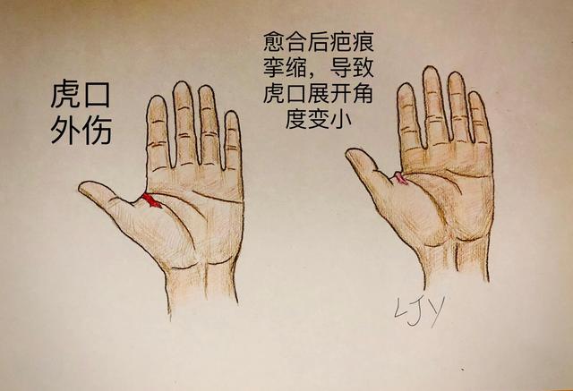 手被割伤了要紧吗:图解日常手部外伤