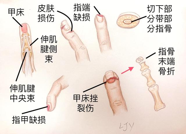 手被割伤了要紧吗:图解日常手部外伤