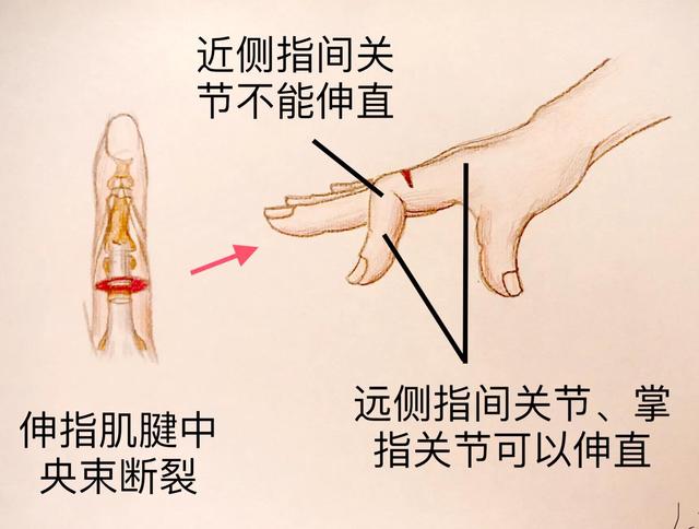 手被割伤了要紧吗:图解日常手部外伤