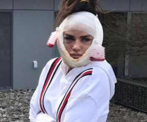 僵尸女(女模特整容失败变“僵尸脸”，从美女整容成了丑女，不敢出门见人)