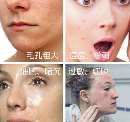 国产黑头收割机,全网销售超400万,5分钟黑头自动“浮”上来