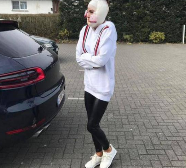 女模特整容失败变“僵尸脸”,从美女整容成了丑女,不敢出门见人