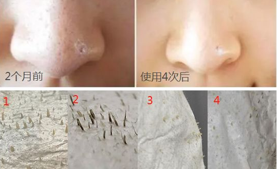 国产黑头收割机,全网销售超400万,5分钟黑头自动“浮”上来