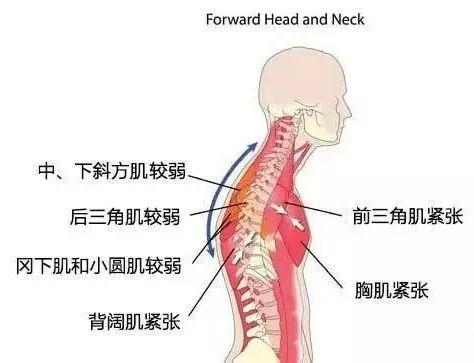 脖子前倾毁了无数人!除了最毁气质,健康危害也不少!