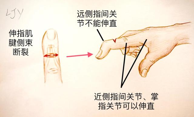手被割伤了要紧吗:图解日常手部外伤