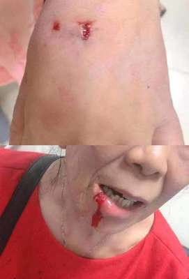 恶狗图片(恶犬街头咬伤21人，最小的才3岁记住这几点能保命)