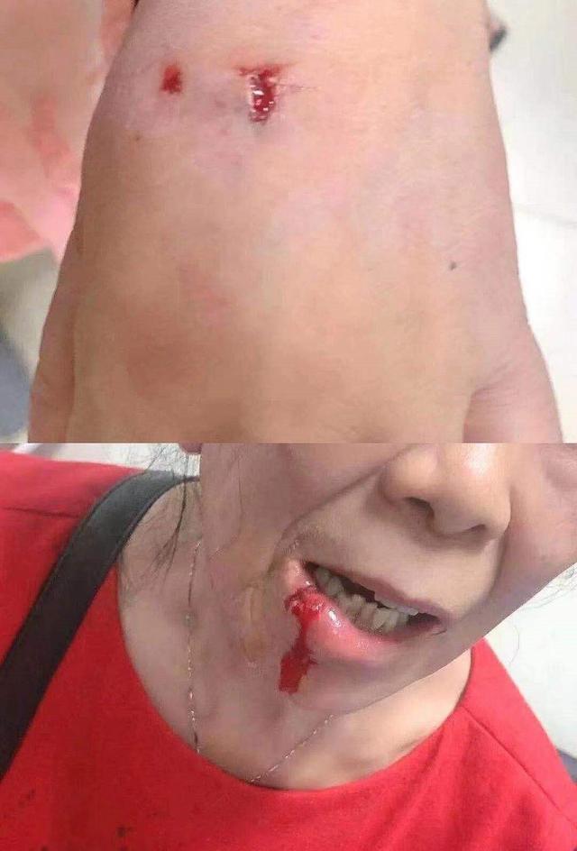恶犬街头咬伤21人,最小的才3岁!记住这几点能保命