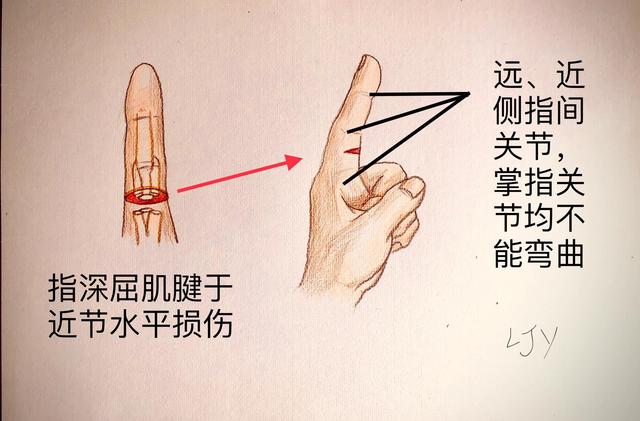 手被割伤了要紧吗:图解日常手部外伤