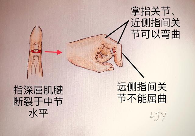 手被割伤了要紧吗:图解日常手部外伤