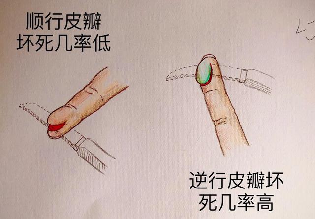 手被割伤了要紧吗:图解日常手部外伤
