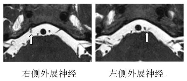 女子车祸致“斗鸡眼”,求医无门!上海医生用了种很新的技术成功治愈