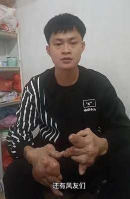 变形计刘一鸣(29岁小伙双手变形如“生姜”，此前知名男星疼得起不来床，这病逐渐年轻化…)