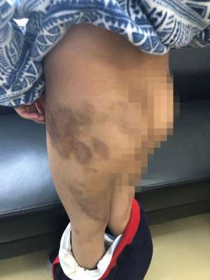 皮带抽屁股(33岁男子多次殴打双胞胎儿子致下肢大面积淤青，被批捕)