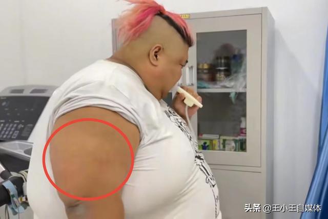 网红胖猴子已减重100斤,胸围高达164cm,腰围比自己身高还多