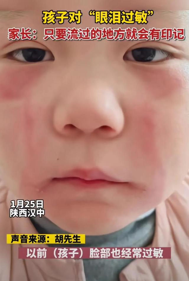 各种奇葩过敏经历,竟然还有对眼泪过敏的