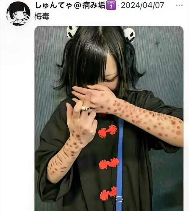日本年轻人怎么了?以得梅毒为傲,感染人数刷新历史