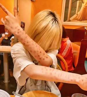 春史(日本年轻人怎么了？以得梅毒为傲，感染人数刷新历史)