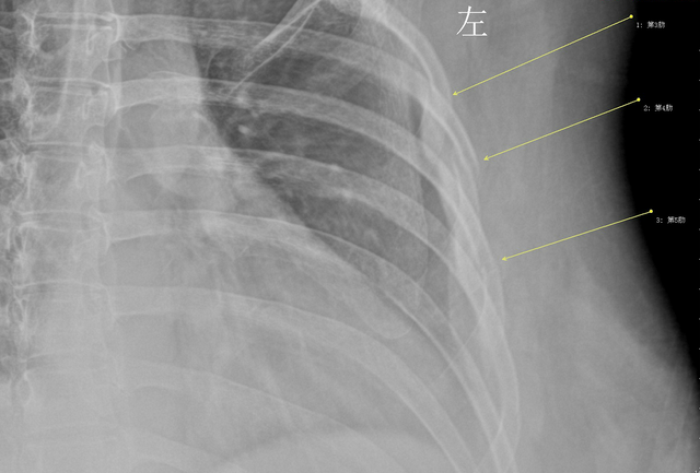女白领咳嗽咳断3根肋骨,骨龄相当60岁老人,竟和她爱喝咖啡有关!