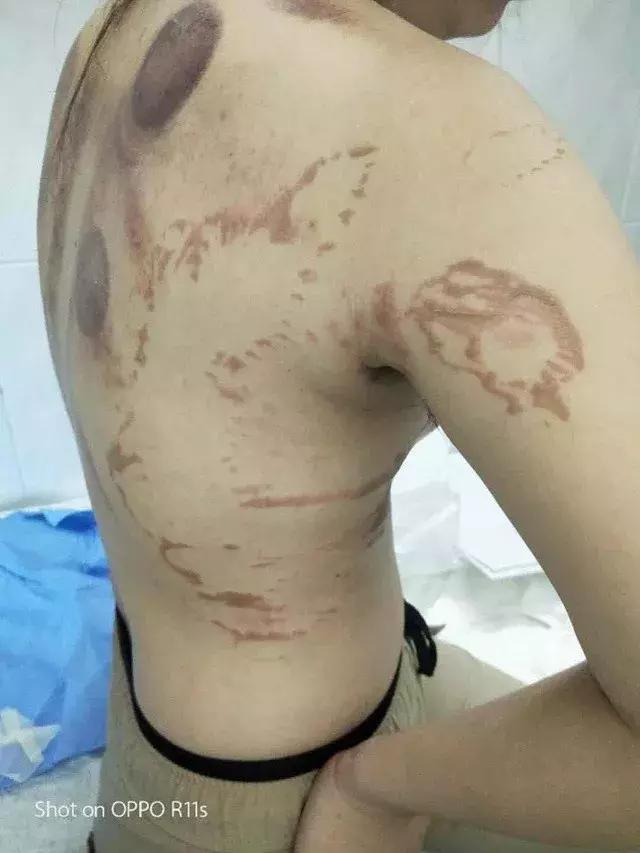 “女主播”拔罐时后背突然起火,涉事美发店员竟是自学技术