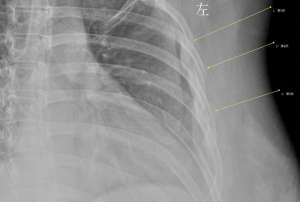 女主播直播胸带掉了(女白领咳嗽咳断3根肋骨，骨龄相当60岁老人，竟和她爱喝咖啡有关)