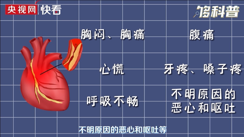 突发心梗趋于年轻化 急救指南一定要看→